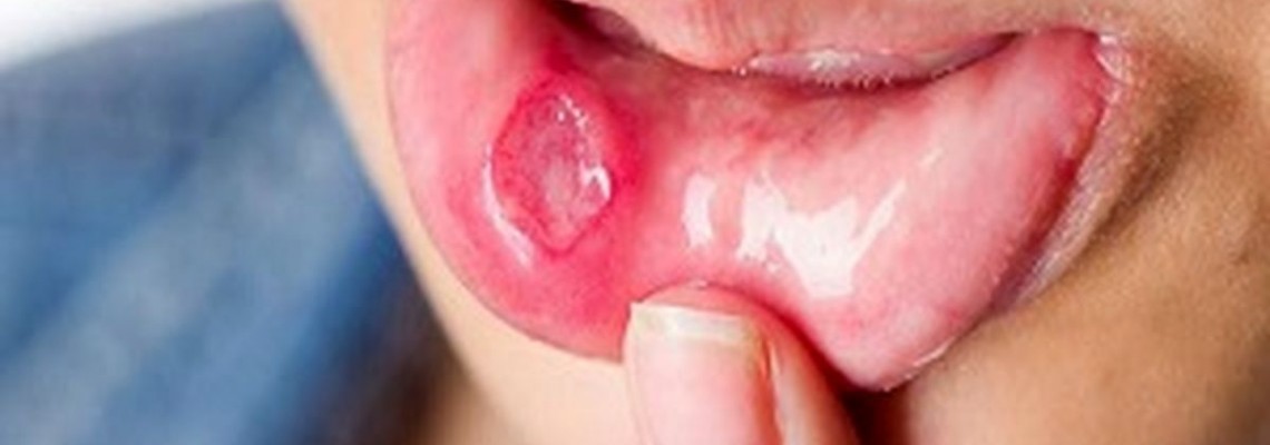 بهبود  آفت دهان |روش هایی برای درمان سریع و خانگی آفت دهان و زبان