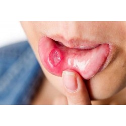 بهبود  آفت دهان |روش هایی برای درمان سریع و خانگی آفت دهان و زبان