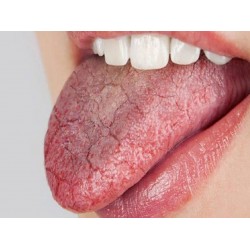 بیماری‌های زبان | بیماری‌های دردناکی که کامتان را تلخ می کنند