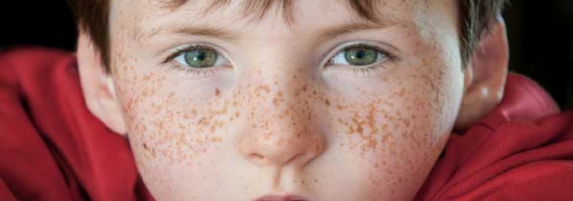 کک و مک | روش های گیاهی درمان این لکه های پوستی- بخش 2