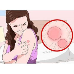 عفونت پوست | آنچه باید درباره عفونت باکتریایی پوست بدانید