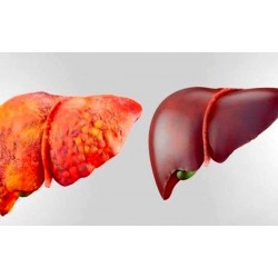 درمان کبد چرب | با درمان خانگی و گیاهی کبدتان را درمان کنید