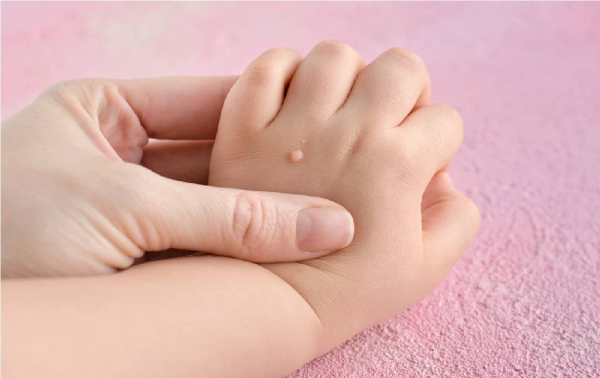 7 درمان زگیل | درمان سریع و خانگی این مهمان های ناخوانده