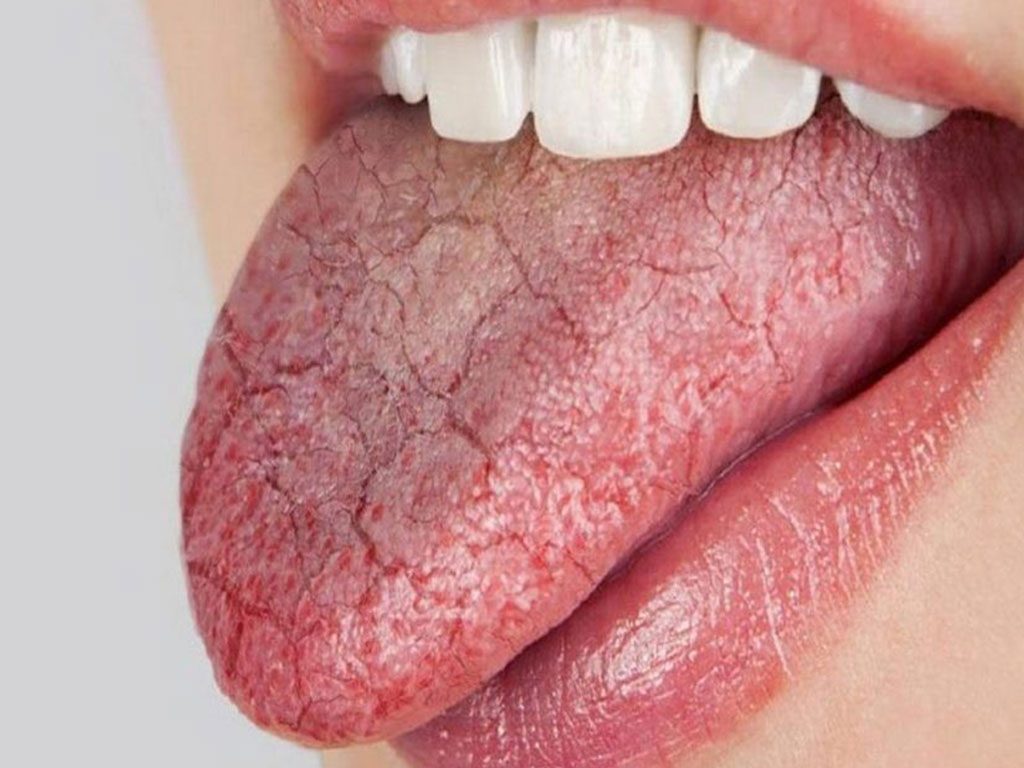 زبان 8 بیماری‌های زبان | بیماری‌های دردناکی که کامتان را تلخ می کنند