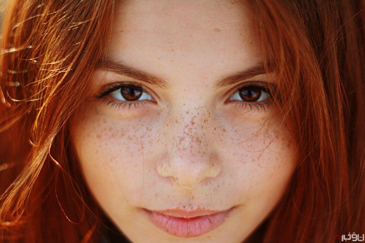 و مک2 کک و مک | روش های گیاهی درمان این لکه های پوستی- بخش 1