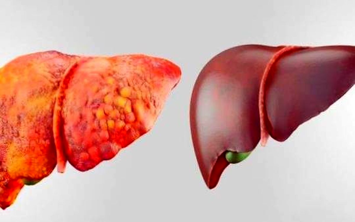 کبد چرب درمان کبد چرب | با درمان خانگی و گیاهی کبدتان را درمان کنید